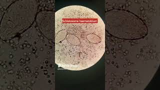 Schistosoma haematobiumSchistosomiasis parasite under microscope microscopy urinalysis [upl. by Johnny]