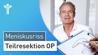 Meniskus OP Meniskusriss arthroskopisch behandeln  Teilresektion [upl. by Ezana]