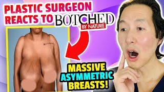 HUGE Asymmetric Breasts  Doctor Reacts to BOTCHED BY NATURE [upl. by Esenaj]