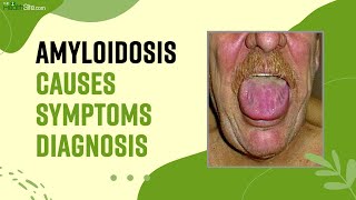 Amyloidosis What Is This Rare Disease Causes Symptoms amp Treatment Of The Amyloidosis [upl. by Biernat]