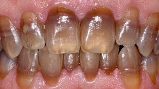 Tetracycline Stained Teeth Under 1 Minute By A DENTIST [upl. by Oiluig]