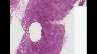 Histopathology Lymph nodeToxoplasmosis [upl. by Braunstein]