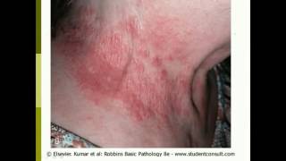 MSS Pathology  Acute amp Chronic Dermatoses  By Deema AlArameen [upl. by Elynad837]