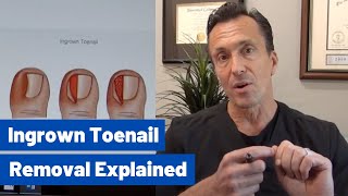 Ingrown Toenail Removal Dr Moore Explains the Permanent Cosmetic Procedure [upl. by Leoni]