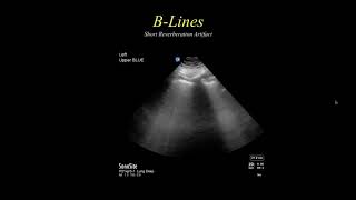 The BLUE Protocol Bedside Lung Ultrasound in Emergency [upl. by Odysseus]