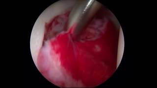 Inflammatory Synovitis  Synovectomy Surgery  Hip Specialist [upl. by Hyps]