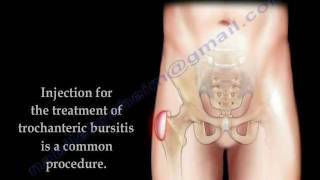 Trochanteric Bursitis Injection  Everything You Need To Know  Dr Nabil Ebraheim [upl. by Annoid]