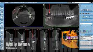 Straumann Romexis Fully Guided Workflow [upl. by Ativad]