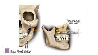 Bloqueio mandibular de boca fechada técnica de vaziraniakinosi [upl. by Viradis]