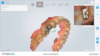 Aoralscan 2 Scansione dente in metallo [upl. by Erreipnaej493]