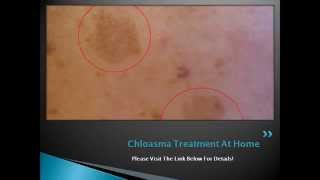 Chloasma Treatment At Home  How to Get Rid of Chloasma or Melasma Naturally [upl. by Mackenzie]