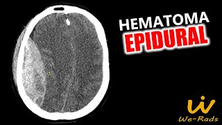 Hematoma Epidural [upl. by Narat]