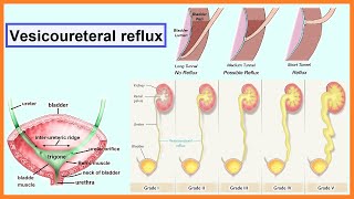 vesicoureteral reflux [upl. by Lisabeth]