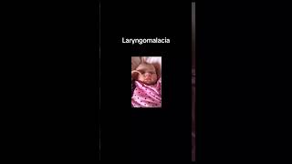 Laryngomalacia [upl. by Monro60]