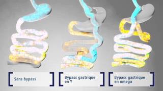 Hernia Hiatal Laparoscopic Surgery PreOp® Patient Education [upl. by Enelloc444]