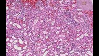 Histopathology KidneyInterstitial nephritis [upl. by Evelin]