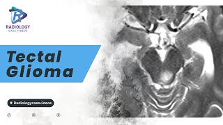 Tectal Glioma [upl. by Rozina946]