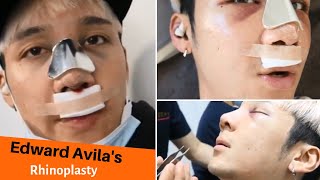 Edward Avilas Rhinoplasty [upl. by Pedaiah]