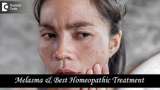 MELASMA OR CHLOASMA  Causes and Best Homeopathic Treatment  Dr V Bhagyalakshmi  Doctors Circle [upl. by Eirellam652]