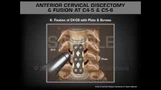 Anterior Cervical Discectomy amp Fusion at C45 and C56 [upl. by Eitsirhc]