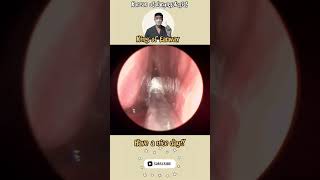 귀지형 콧물 부비동염 축농증 비염 코청소 이비인후과 rhinorrhea rhinitis sinusitis asmr ENT entdoctor [upl. by Aicelf]