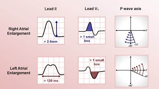 Intro to EKG Interpretation  Chamber Enlargement [upl. by Bertine31]