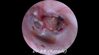 Double Traumatic Tympanic Membrane  Eardrum  Perforation [upl. by Bakeman]