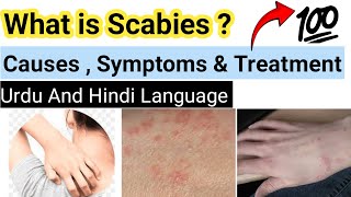 What is scabies CausesSymptoms amp Treatment  👉 In Urdu [upl. by Unam445]