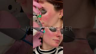 Treat facial redness amp rosacea with our VBeam Perfecta laser treatment at Wise Med Spa in Wayne NJ [upl. by Ogren]