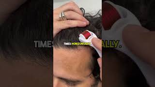 How to use the Derma Roller for Hair Loss [upl. by Leseil443]