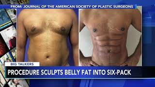 New procedure uses foam to sculpt belly fat into 6pack abs [upl. by Edwin]