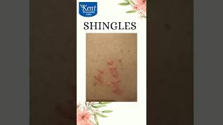 Shingles Best homeopathy treatment Drkukreja kalani online consult8291492566 [upl. by Jollenta]