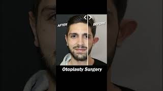 Otoplasty Surgery earsurgery [upl. by Einot]