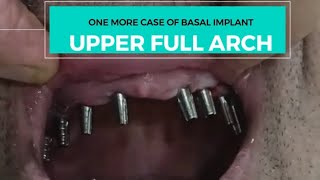 बसल इम्प्लांट्स का एक और कामयाब केसFULL MOUTH CASE OF BASAL IMPLants in just 5 days basalimplants [upl. by Evante]