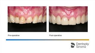 Gingival troughing with SiroLaser Blue before CEREC Upper Frontal Veneering [upl. by Hoffmann412]