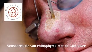 Neuscorrectie van rhinophyma met de CO2 laser [upl. by Semele]