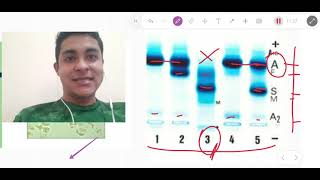 Hemoglobinopatias com ênfase em anemia falciforme [upl. by Layol]