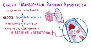 Pulmonary hypertension causes symptoms diagnosis treatment pathology [upl. by Lambard]