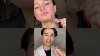 Pimple Patch Secret dermreacts acne skincare [upl. by Stanly]