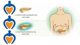 Diabetes  The different types of diabetes and its treatment [upl. by Llednik]