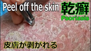 Endless Skin peeling Part2 乾癬 Psoriasis Peel  银屑病 건선 Schuppenflechte Psoriasi かんせん はがし【閲覧注意】 [upl. by Reivax]