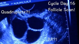 TTC Update CD16 Follicle Scan [upl. by Nolek]