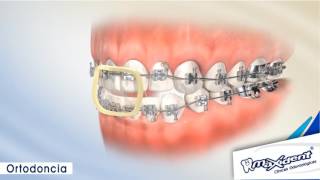 Corrección de mordida y espacios dentales quotOrtodonciaquot [upl. by Beltran48]