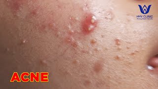 HHV Clinic  dothuhien  hienvanspa  acne extraction  Vu Yen Nhi  part 2 [upl. by Wan]