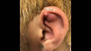 Left Ear Helix Abscess Chondritis or Not [upl. by Paten]