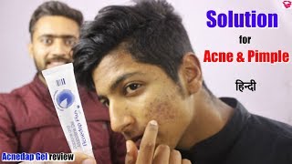 Best gel for Acne and Pimples  Effect Results How to use  Acnedap plus gel review [upl. by Heyer]