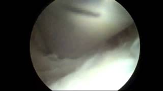 Endoscopic Olecranon Bursa Excision at Elbow by Houston TX Orthopedic Surgeon Dr Jeffrey E Budoff [upl. by Perlie646]