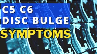 What Are The Symptoms Of A Bulging Disc In The Neck C5 C6 Disc Bulge Symptoms  Dr Walter Salubro [upl. by Aidnic]