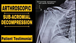 ARTHROSCOPIC SUBACROMIAL DECOMPRESSION PATIENT TESTIMONIAL [upl. by Luane677]