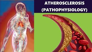 Atherosclerosis – Artery Disease Plaque Formation Risk Factors and Prevention Pathophysiology [upl. by Bradleigh]